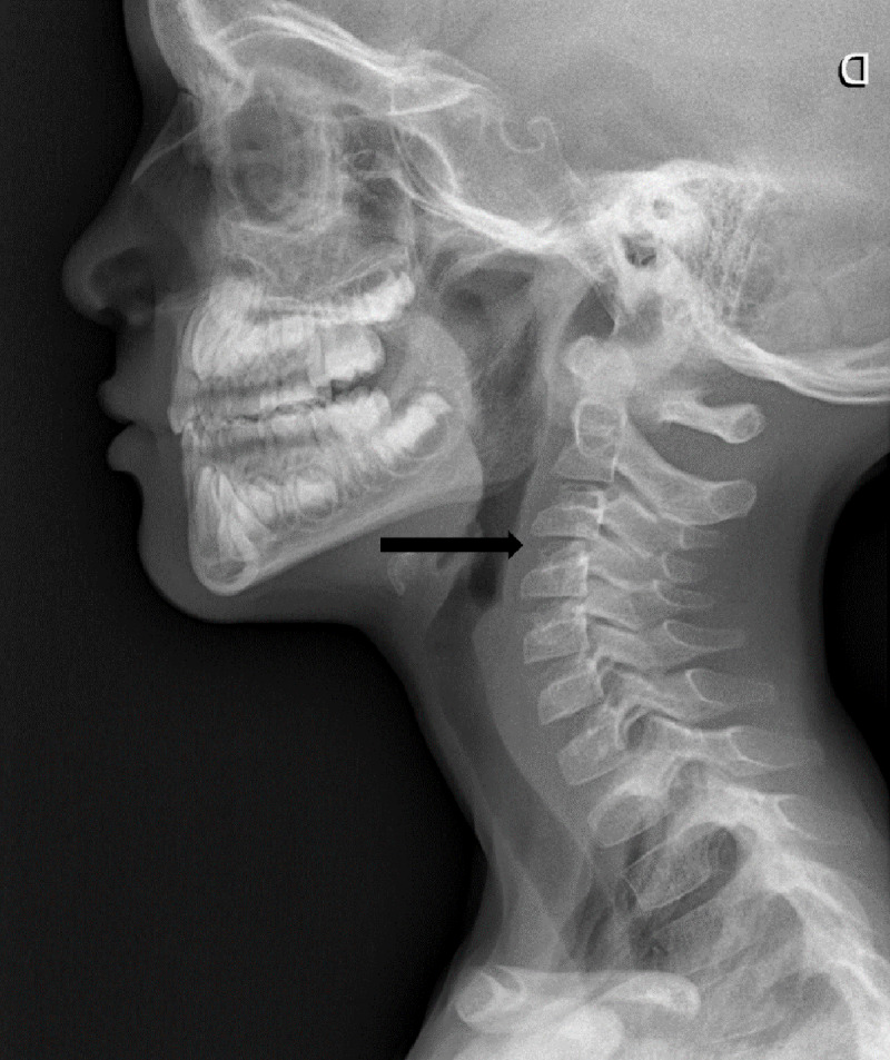 Cervical Interspinous Ligament Sprain in a 6-Year-Old Boy.