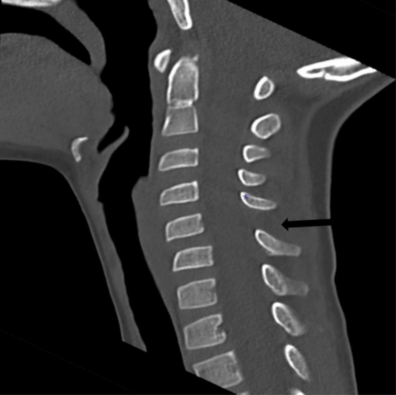 Cervical Interspinous Ligament Sprain in a 6-Year-Old Boy.