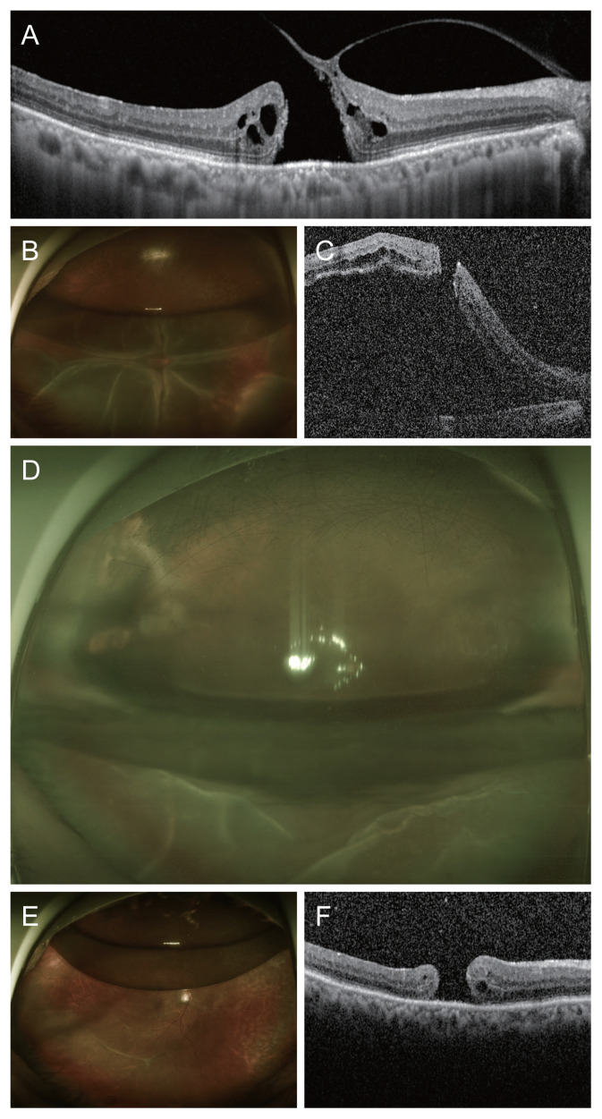 Spontaneous Resolution of Retinal Detachment that Occurred Following Vitrectomy for Macular Hole: A Case Report.