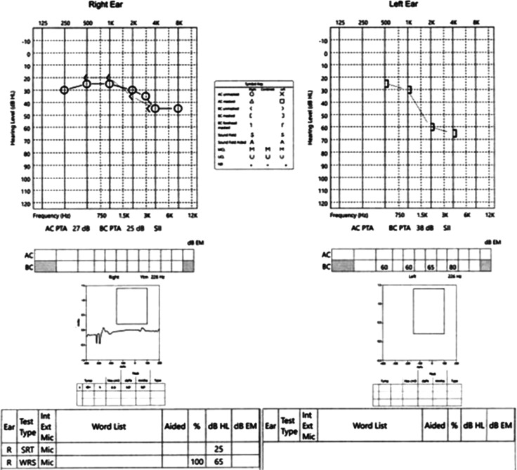 Inverted Papilloma of the Middle Ear: Two New Cases and Systematic Review.