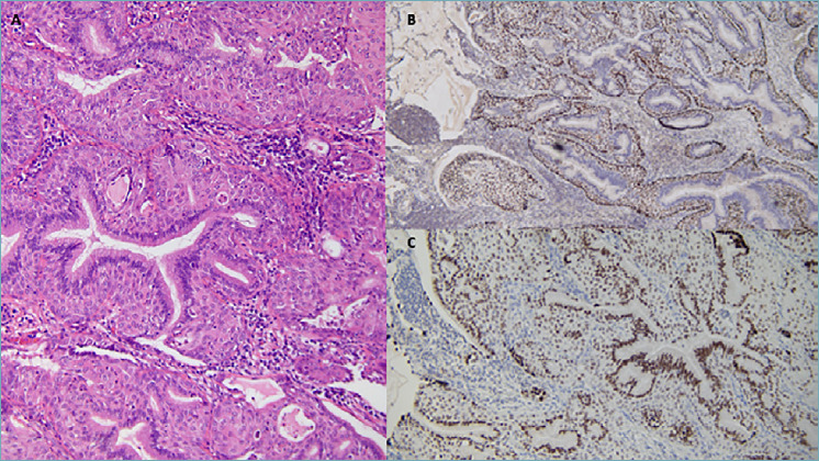 Pulmonary mixed squamous and glandular papilloma: diagnostic challenges of a rare lesion when the clock is ticking. How to avoid interpretation mistakes.