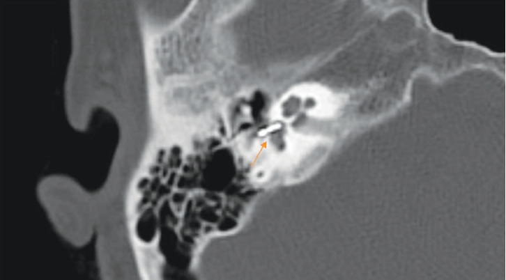 Removal and Repositioning of a Piston Wire Prosthesis That Entered the Vestibule Secondary to Trauma in a Patient Who Underwent Stapedotomy.