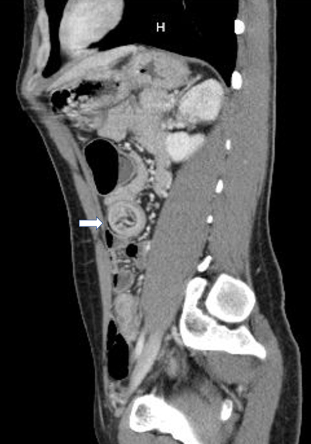 Adult Intussusception in Chronic Marijuana Users.