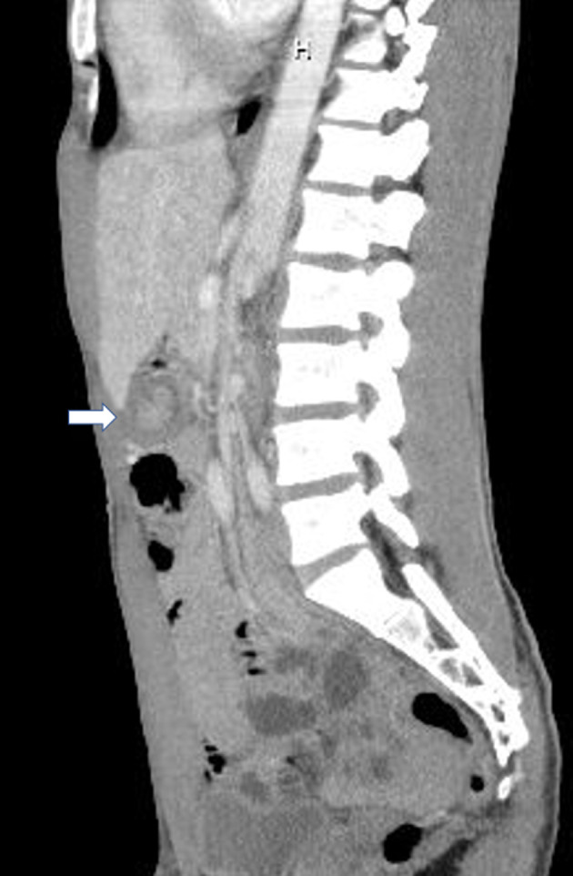 Adult Intussusception in Chronic Marijuana Users.