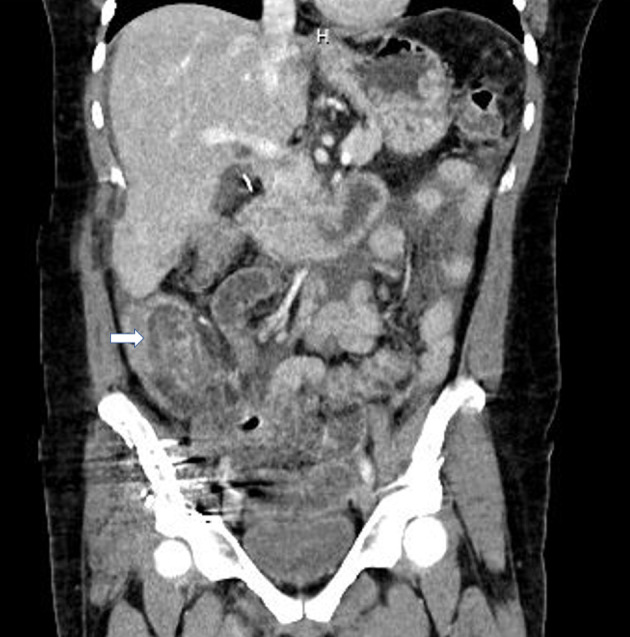 Adult Intussusception in Chronic Marijuana Users.