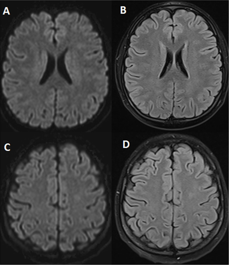 Methotrexate-Induced Stroke-Like Encephalopathy: Beware the Stroke Mimic.