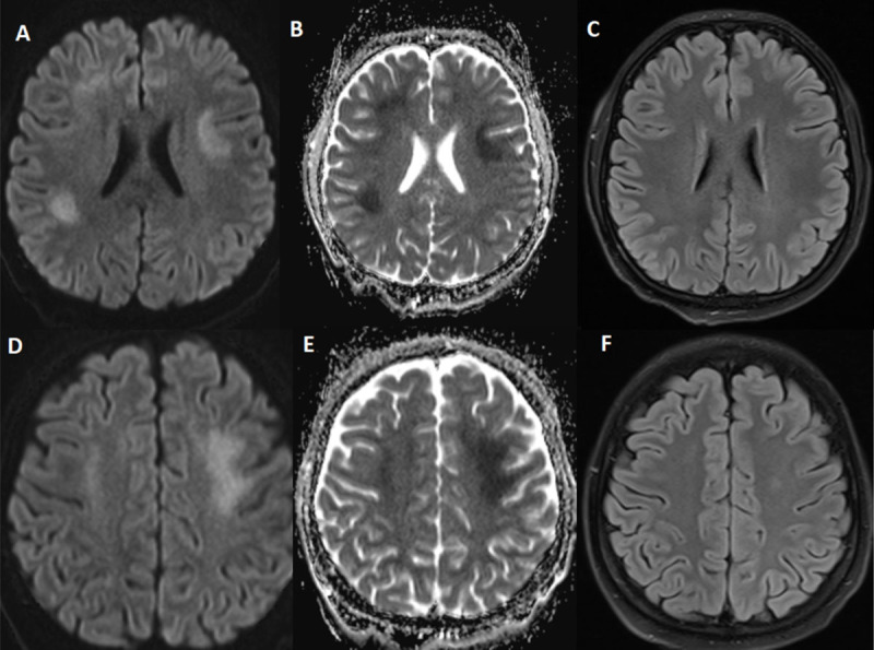 Methotrexate-Induced Stroke-Like Encephalopathy: Beware the Stroke Mimic.