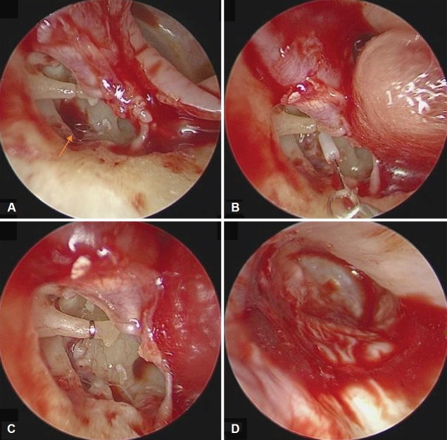 Removal and Repositioning of a Piston Wire Prosthesis That Entered the Vestibule Secondary to Trauma in a Patient Who Underwent Stapedotomy.