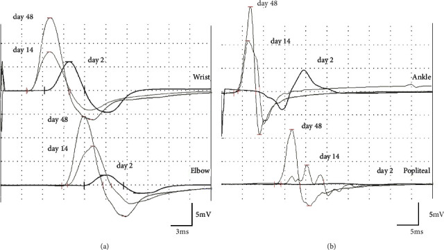 Guillain-Barré Syndrome Associated with COVID-19 in a Japanese Male.