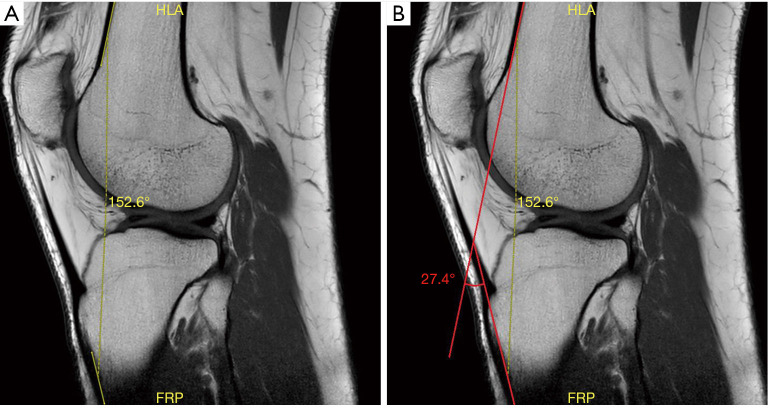 Inter- and intra-rater reliability of knee flexion angle measurements on X-ray and MRI.