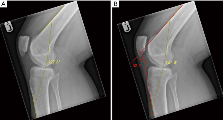 Inter- and intra-rater reliability of knee flexion angle measurements on X-ray and MRI.