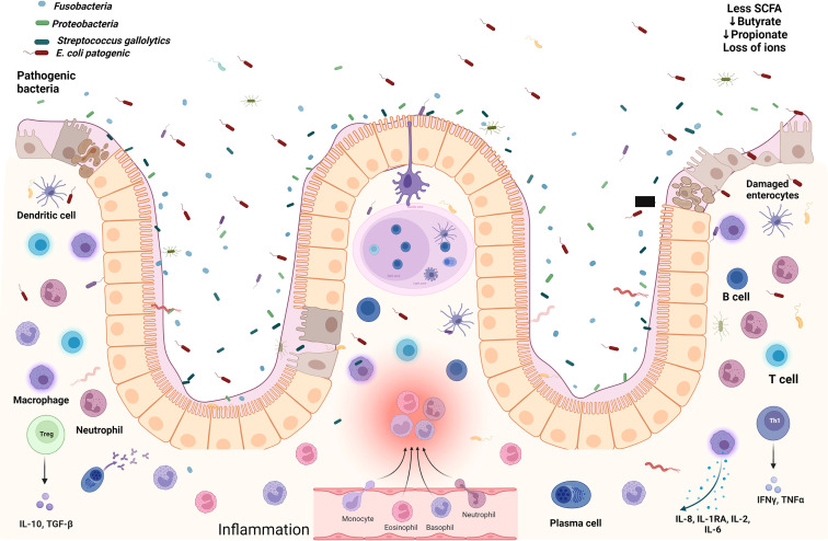 The synergistic interaction of systemic inflammation, dysbiosis and antimicrobial resistance promotes growth restriction in children with acute severe malnutrition: An emphasis on <i>Escherichia coli</i>.