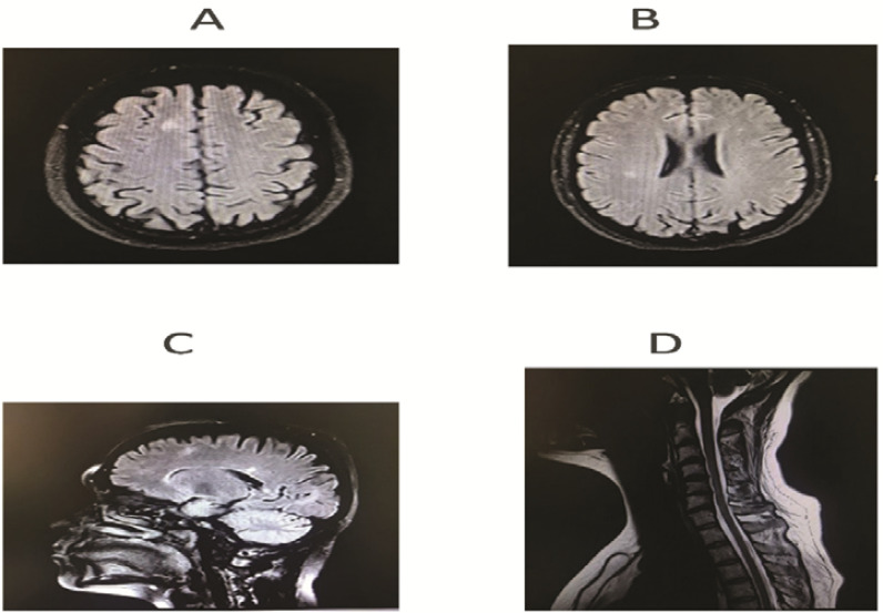 Initial clinical presentation of multiple sclerosis with concurrent COVID-19 infection: Case report and literature review.