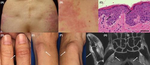 Adult-onset Still's disease following mRNA-1273 Moderna COVID-19 vaccination: A case report