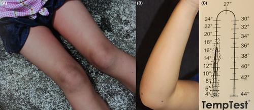 Cold-induced anaphylactic shock during playing in a thigh-deep river: A pediatric case