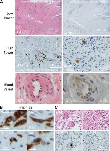 pTDP-43 aggregates accumulate in non-central nervous system tissues prior to symptom onset in amyotrophic lateral sclerosis: a case series linking archival surgical biopsies with clinical phenotypic data