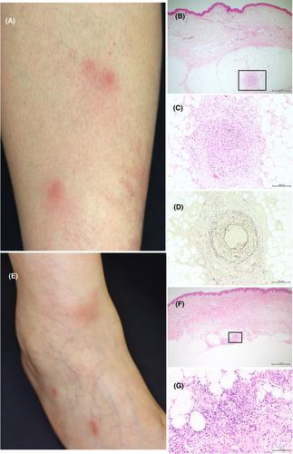 Relapsing erythema nodosum-like eruption in a patient with granulomatosis with polyangiitis