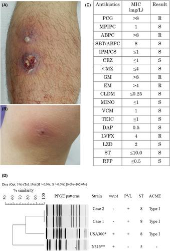 Simultaneous infection in a couple by Panton-Valentine leukocidin-positive methicillin-susceptible Staphylococcus aureus related to the USA300 clone