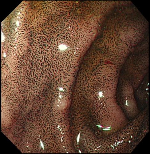 Black pigmentation in duodenum