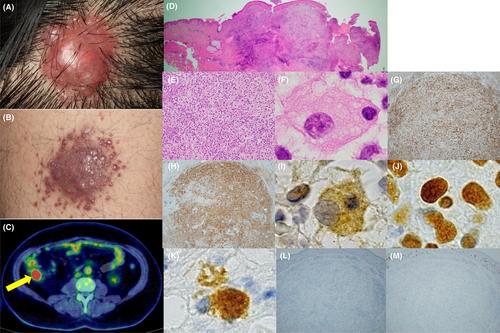 A case of disseminated extranodal Rosai–Dorfman disease diagnosed by skin manifestations