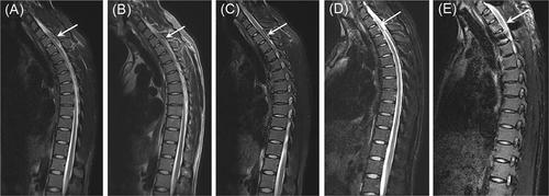 Thoracic epidural arteriovenous malformation causing rapidly progressive myelopathy and mimicking an acute transverse myelitis: A case report