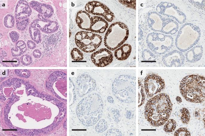 Learning to distinguish progressive and non-progressive ductal carcinoma in situ