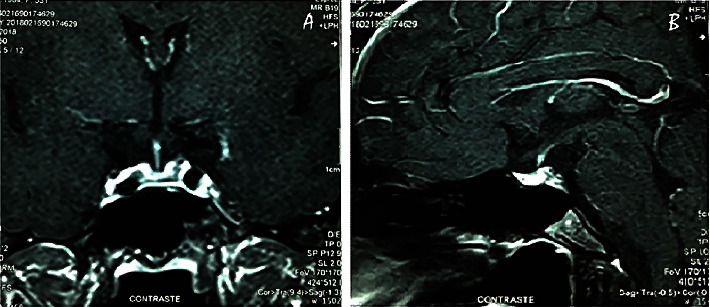 Acute Sheehan's Syndrome Presenting with Hyponatremia Followed by a Spontaneous Pregnancy.