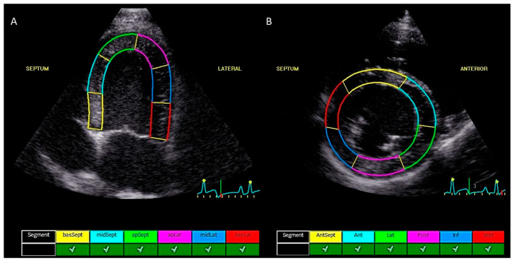 Assessment of Cardiotoxicity after a Single Dose of Combretastatin A4-Phosphate in Dogs Using Two-Dimensional Speckle-Tracking Echocardiography.