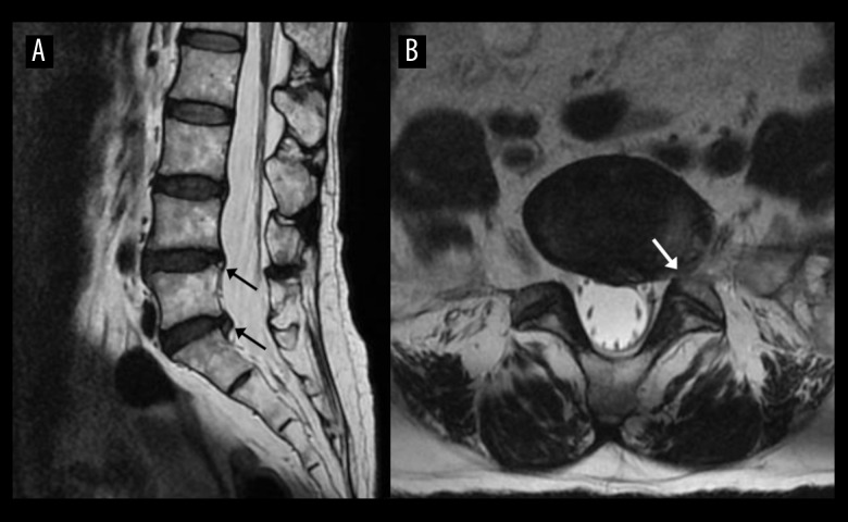 Thoracic Schwannoma as an Unusual Cause of Sciatic Pain in the Chiropractic Office: A Case Report.