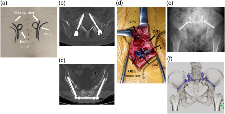 Clinical Outcome of Sacroiliac Rod Fixation for Fragility Fracture of the Pelvis Rommens and Hoffman Classification Type IVb: Case Series.