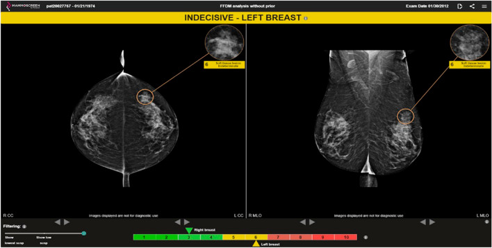 Impact of artificial intelligence in breast cancer screening with mammography.
