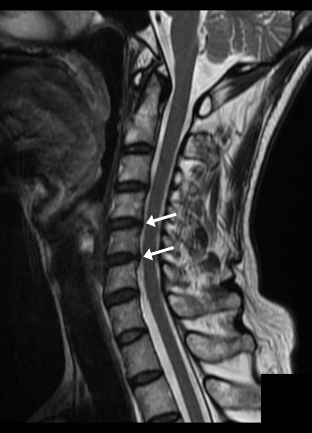 Thoracic Schwannoma as an Unusual Cause of Sciatic Pain in the Chiropractic Office: A Case Report.