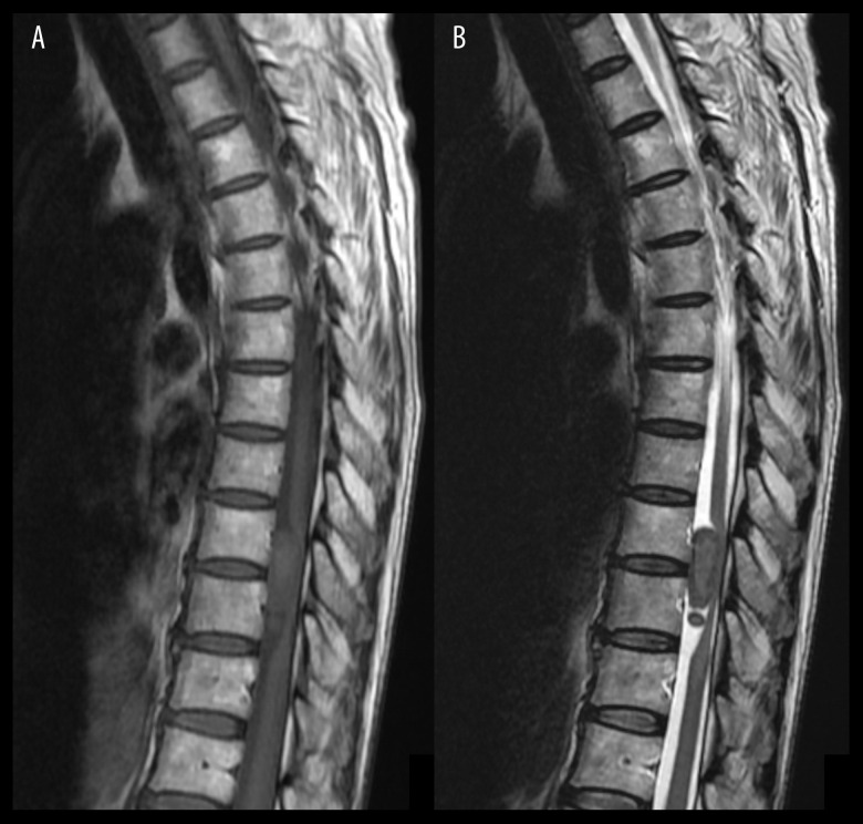 Thoracic Schwannoma as an Unusual Cause of Sciatic Pain in the Chiropractic Office: A Case Report.