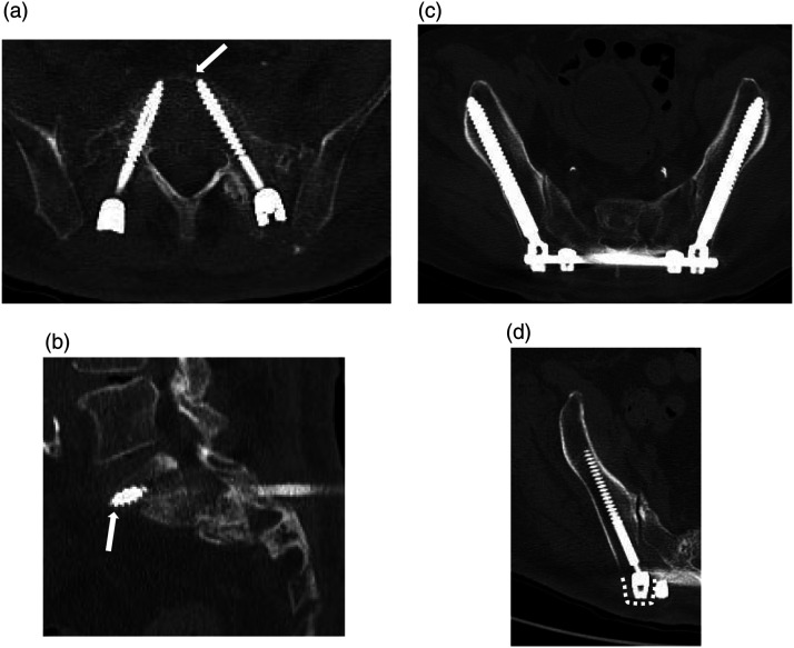 Clinical Outcome of Sacroiliac Rod Fixation for Fragility Fracture of the Pelvis Rommens and Hoffman Classification Type IVb: Case Series.