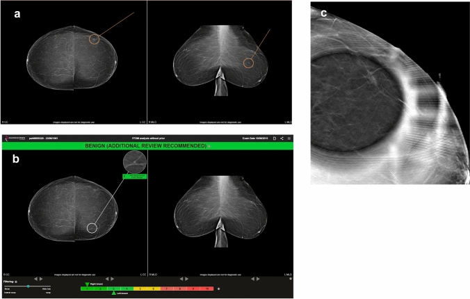Impact of artificial intelligence in breast cancer screening with mammography.