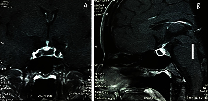 Acute Sheehan's Syndrome Presenting with Hyponatremia Followed by a Spontaneous Pregnancy.
