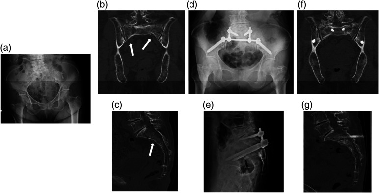 Clinical Outcome of Sacroiliac Rod Fixation for Fragility Fracture of the Pelvis Rommens and Hoffman Classification Type IVb: Case Series.