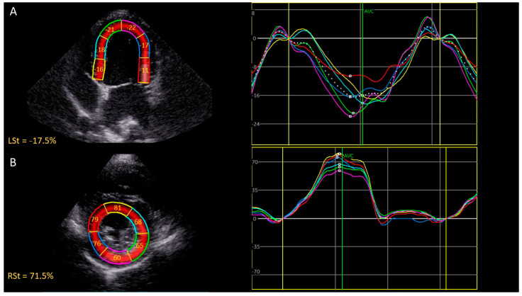 Assessment of Cardiotoxicity after a Single Dose of Combretastatin A4-Phosphate in Dogs Using Two-Dimensional Speckle-Tracking Echocardiography.