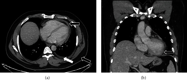 Acute Inflammatory Pericarditis following First Dose of COVID-19 Vaccine (AstraZeneca).