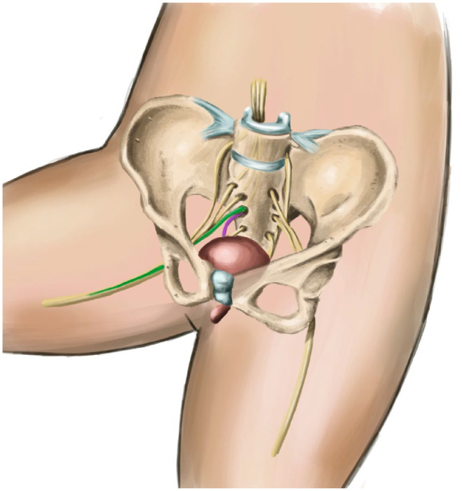 Current role of neuromodulation in bladder pain syndrome/interstitial cystitis.