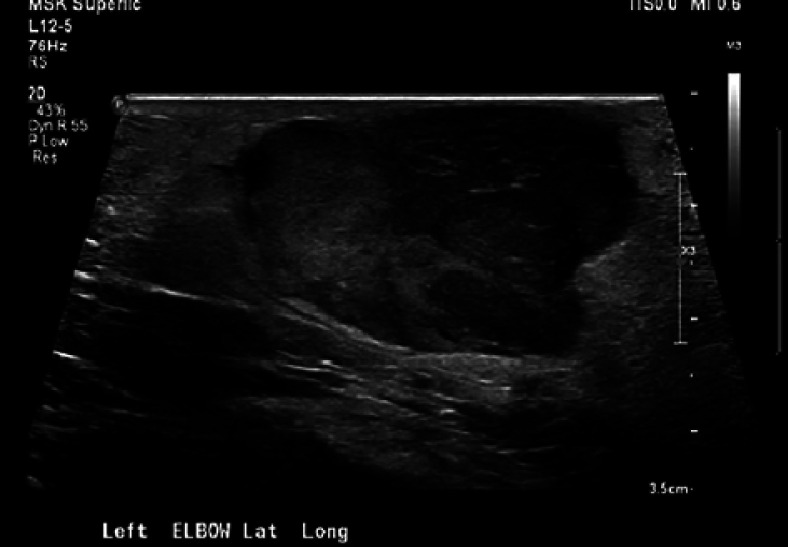 An Unusual Presentation of Merkel Cell Carcinoma in the Setting of Immunosuppression on TNF-Alpha Inhibitor Therapy.