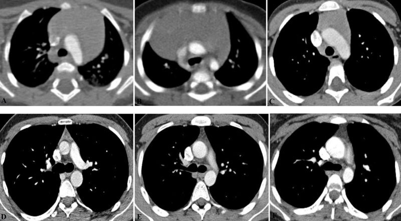 Multidetector Computed Tomographic Evaluation of the Normal Characteristics of the Thymus in the Pediatric Population.