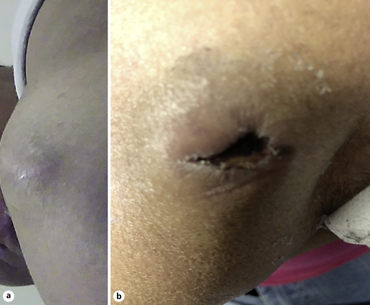 An Unusual Presentation of Merkel Cell Carcinoma in the Setting of Immunosuppression on TNF-Alpha Inhibitor Therapy.