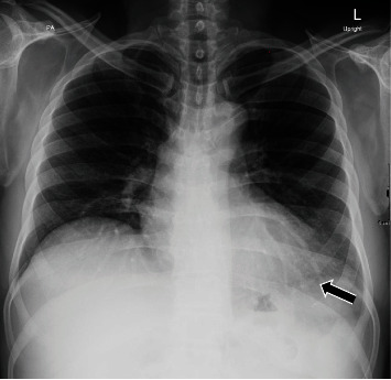 Acute Inflammatory Pericarditis following First Dose of COVID-19 Vaccine (AstraZeneca).