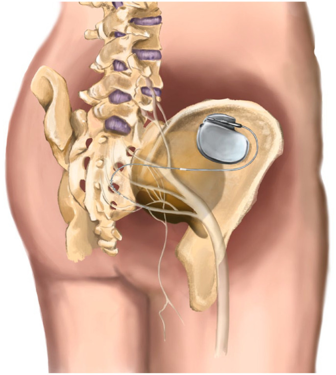 Current role of neuromodulation in bladder pain syndrome/interstitial cystitis.