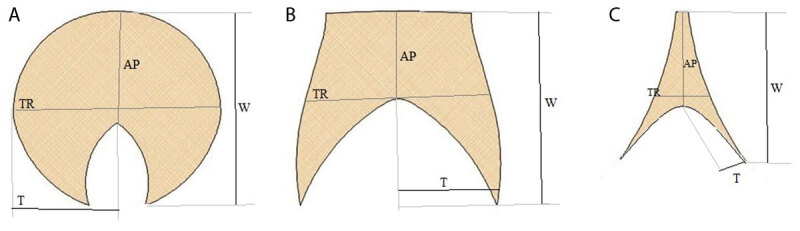 Multidetector Computed Tomographic Evaluation of the Normal Characteristics of the Thymus in the Pediatric Population.