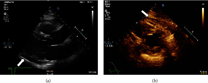 Acute Inflammatory Pericarditis following First Dose of COVID-19 Vaccine (AstraZeneca).