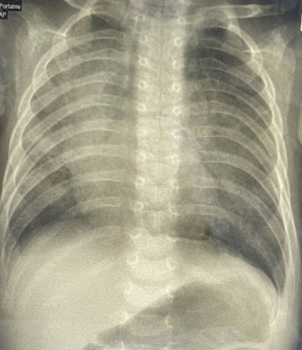 An Infant Presenting with Interstitial Lung Disease Diagnosed Later as Hunter Syndrome: A Case Report.