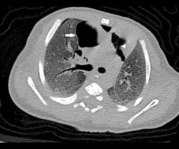 An Infant Presenting with Interstitial Lung Disease Diagnosed Later as Hunter Syndrome: A Case Report.