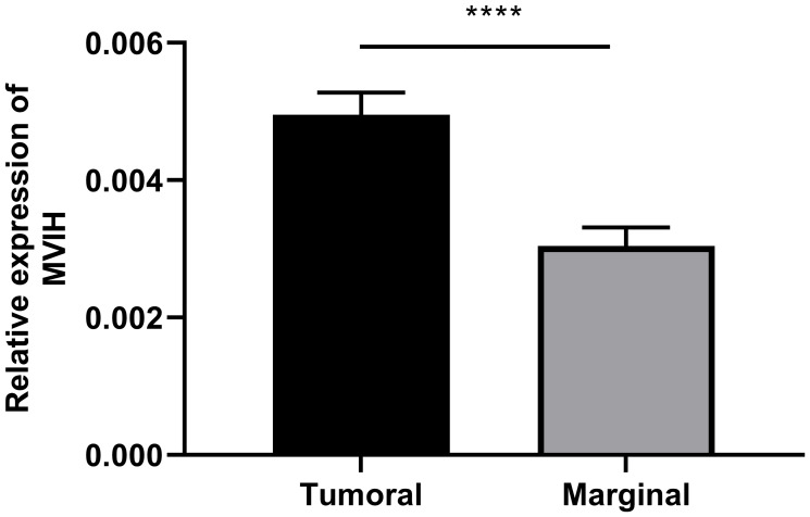 Ectopic expression of lncRNA MVIH as a potential diagnostic biomarker in cervical cancer.